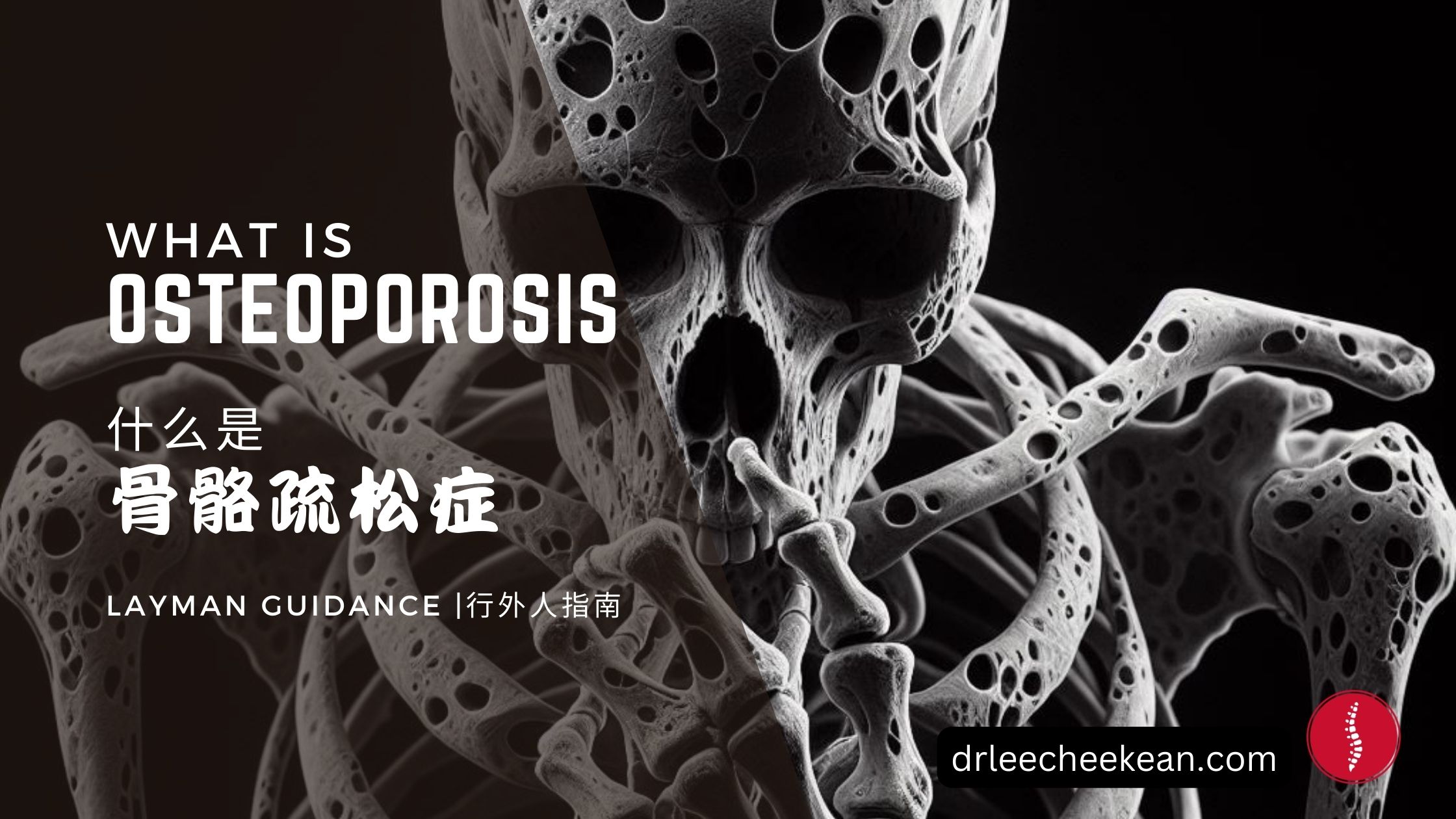 Osteoporosis Layman Guidance 骨质疏松症的行外人指南