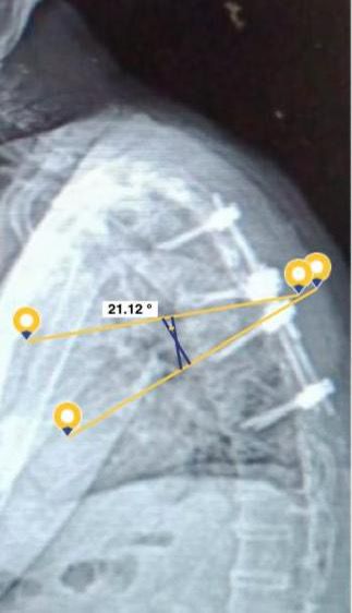 Ankylosing Spondylitis PSO Pre and Post Operation 强直性脊椎炎经椎弓根椎体截骨术手术前后