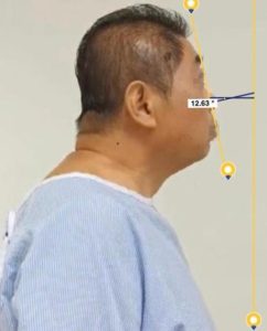 Ankylosing Spondylitis Post Operation Improved Horizontal Gaze 