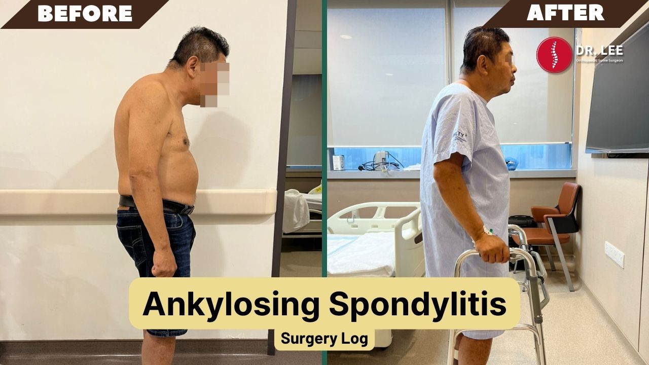 Ankylosing Spondylitis: Thoracic Pedicle Substraction Osteotomy (PSO)