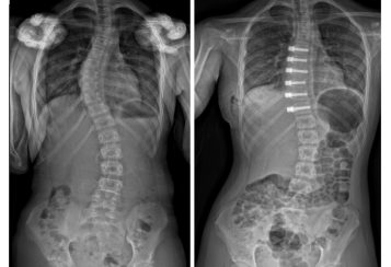 Vertebral Body Tethering Surgery For Scoliosis