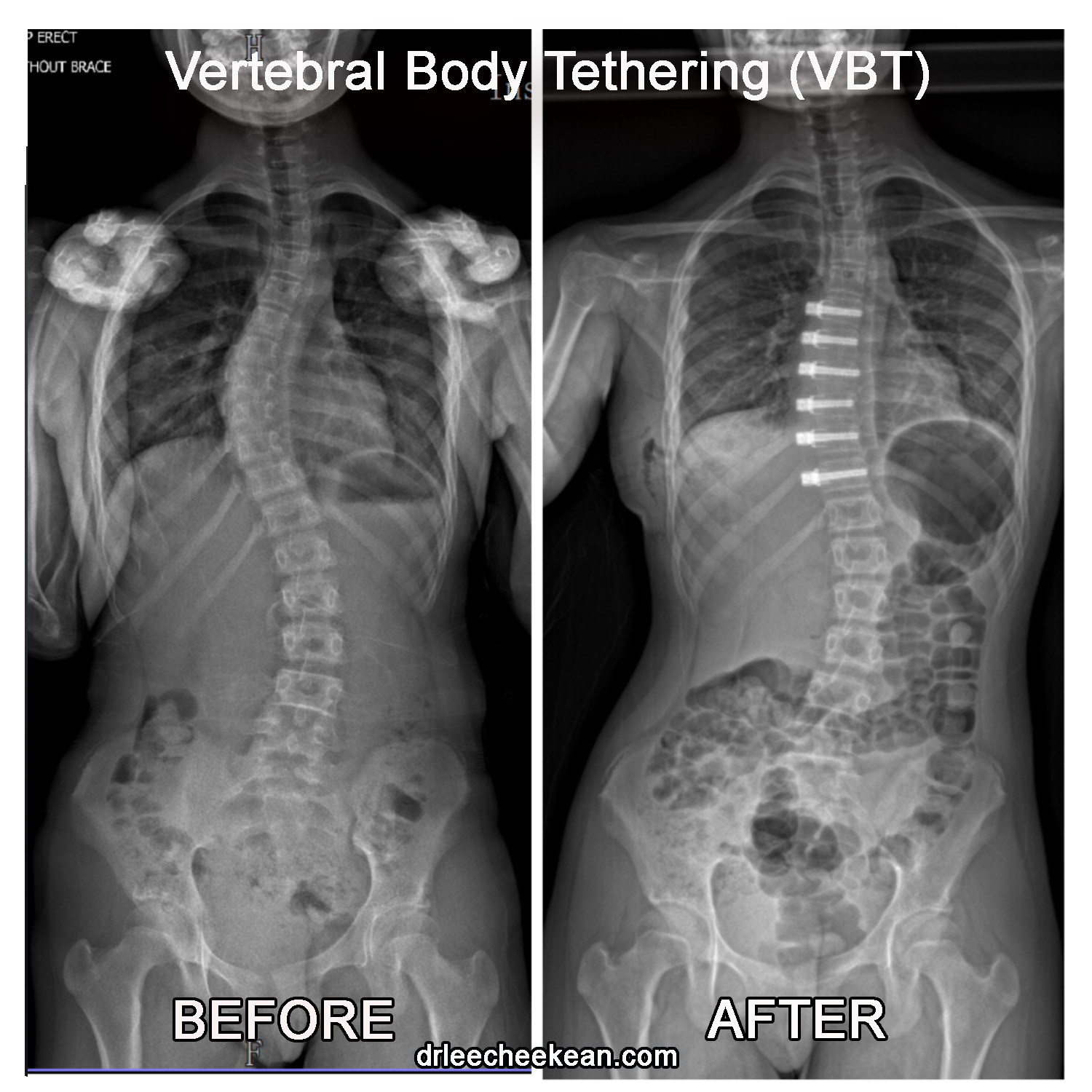 VBT Case Study Before After Scoliosis by Alty Hospital Lee Chee Kean