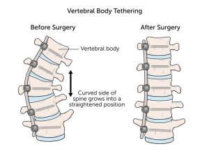 vbt for scoliosis Illustration